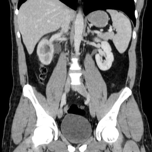 File:Obstructing ureteric calculus (Radiopaedia 18615-18514 C 43).jpg