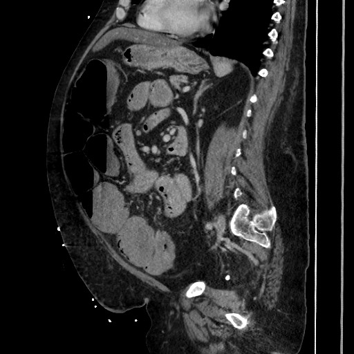 Obstructive colonic diverticular stricture (Radiopaedia 81085-94675 C 143).jpg