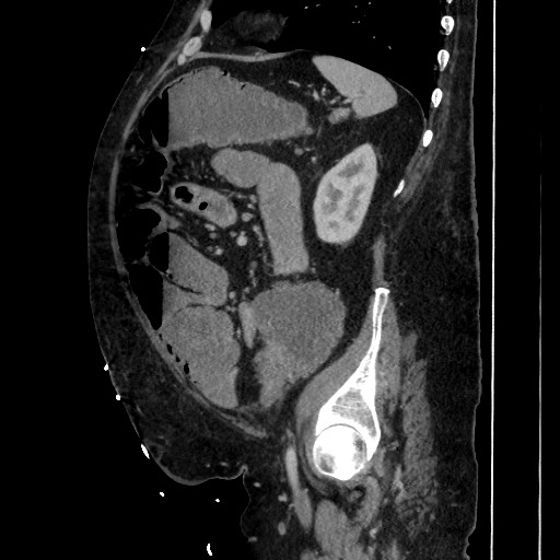 Obstructive colonic diverticular stricture (Radiopaedia 81085-94675 C 167).jpg