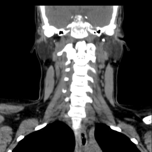 File:Obstructive sleep apnea (CT evaluation) (Radiopaedia 24304-24582 Coronal non-contrast 60).jpg