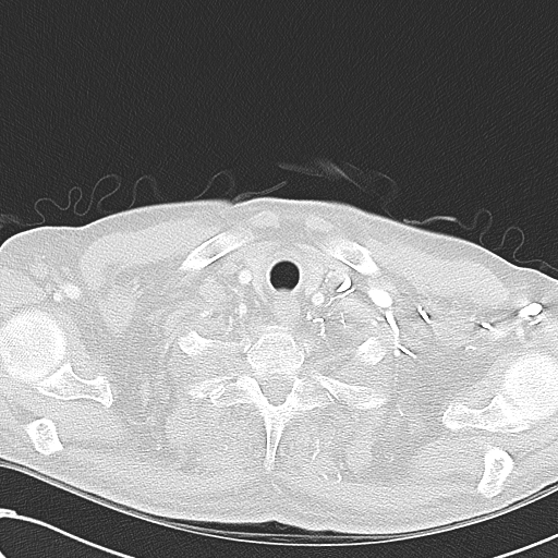 File:Obstructive superior vena cava tumor thrombus (Radiopaedia 28046-28306 Axial lung window 3).jpg