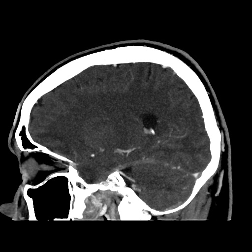 Occipital extradural hematoma simulating venous sinus thrombosis (Radiopaedia 46514-50964 D 29).jpg