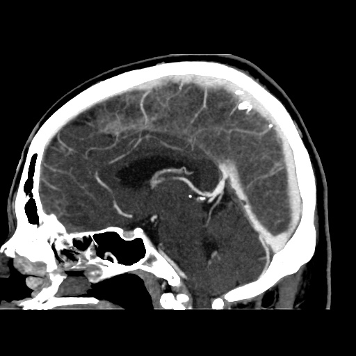 Occipital extradural hematoma simulating venous sinus thrombosis (Radiopaedia 46514-50964 D 41).jpg