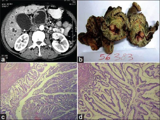 a-d)Intraductal papillary mucinous neoplasm: Radiological and pathological findings