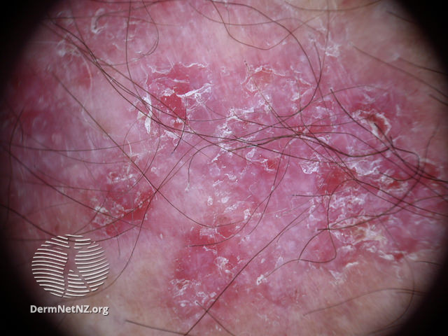 File:Superficial basal cell carcinoma dermoscopy (DermNet NZ sbcc-arm-11-dn).jpg