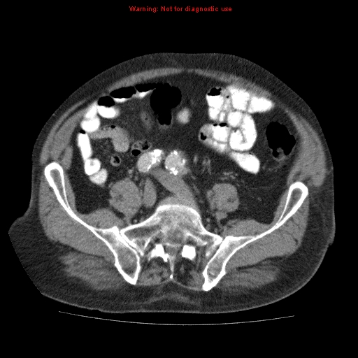Abdominal aortic aneurysm (Radiopaedia 10122-10660 Axial C+ portal venous phase 56).jpg