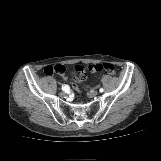 File:Abdominal aortic aneurysm (Radiopaedia 13341-13340 Axial C+ arterial phase 199).jpg