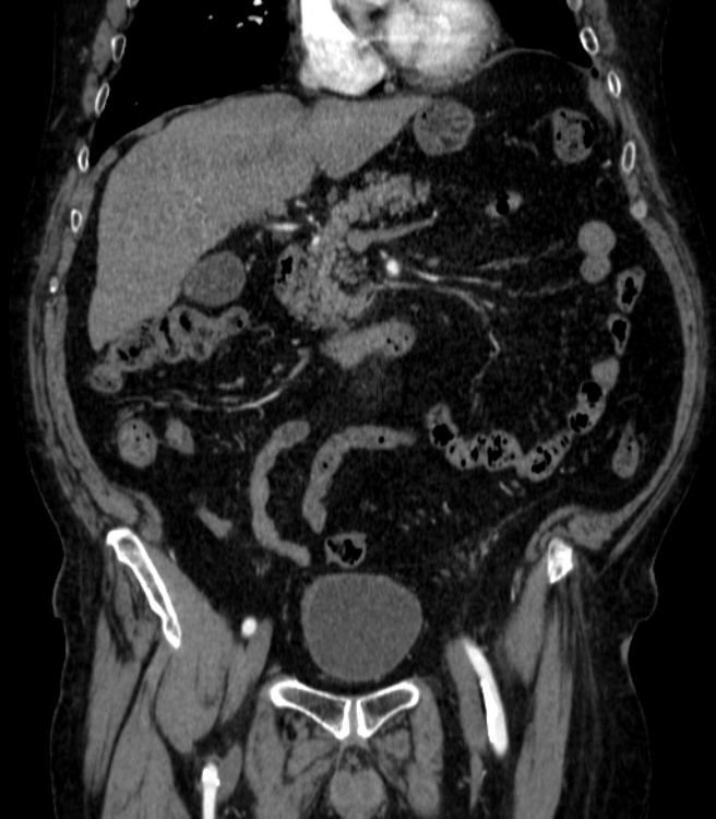 Abdominal aortic aneurysm (Radiopaedia 25855-26001 Coronal C+ arterial phase 18).jpg