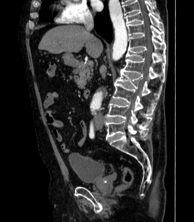 Abdominal aortic aneurysm (Radiopaedia 25855-26001 Sagittal C+ arterial phase 21).jpg