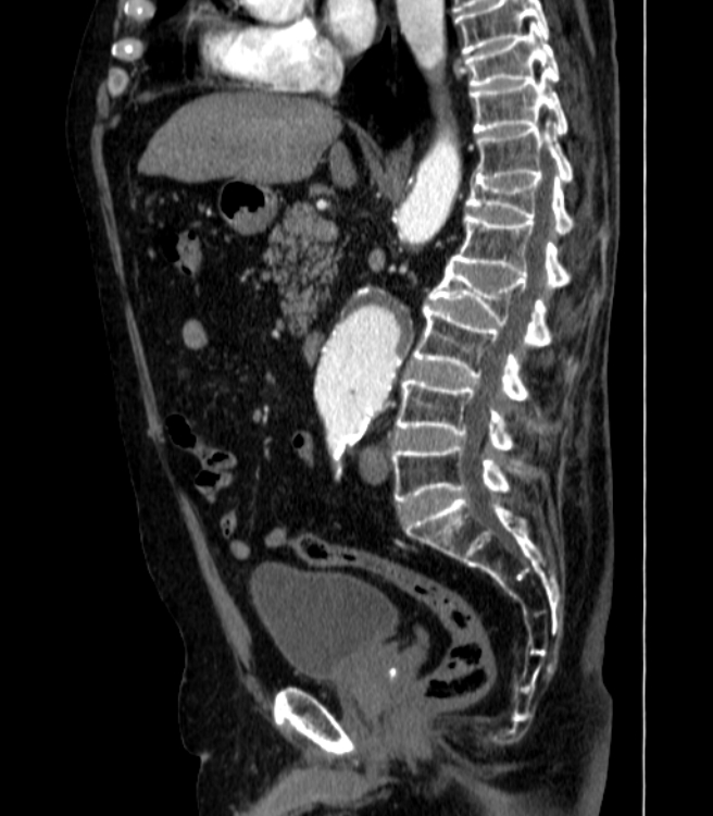 Abdominal aortic aneurysm (Radiopaedia 25855-26001 Sagittal C+ arterial phase 25).jpg