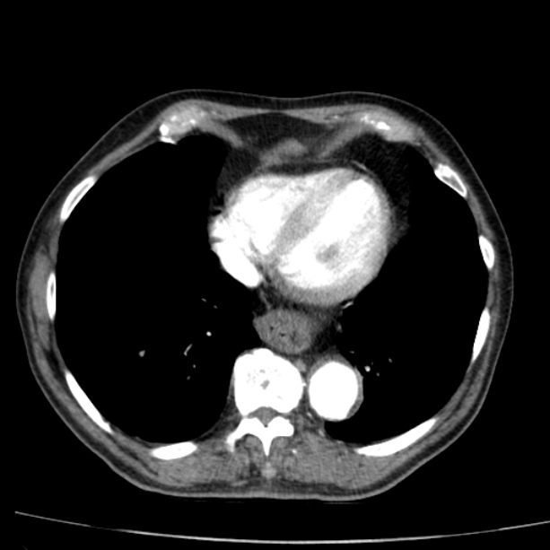 Abdominal aortic aneurysm (Radiopaedia 29248-29660 Axial C+ arterial phase 2).jpg