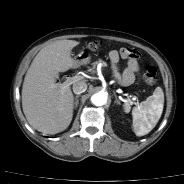 Abdominal aortic aneurysm (Radiopaedia 29248-29660 Axial C+ arterial phase 24).jpg