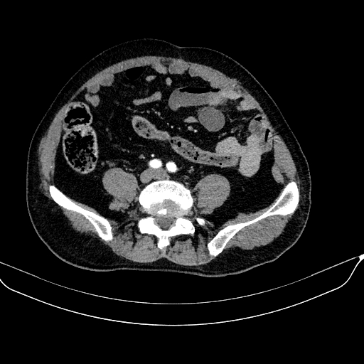 Abdominal aortic aneurysm (Radiopaedia 67117-76452 Axial C+ arterial phase 92).jpg