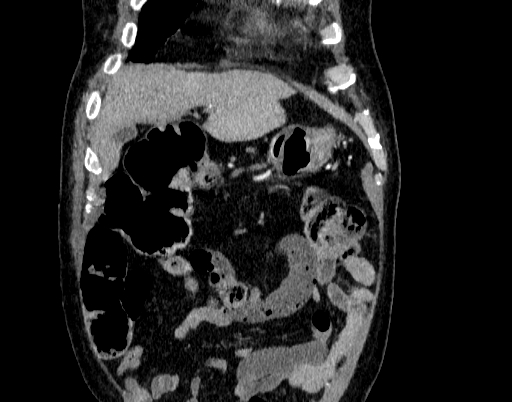 Abdominal aortic aneurysm (Radiopaedia 67117-76452 Coronal C+ arterial phase 2).jpg