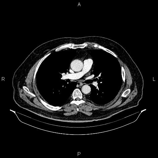 Abdominal aortic aneurysm (Radiopaedia 83094-97462 Axial renal cortical phase 37).jpg