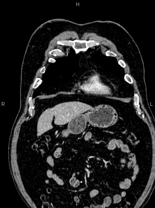 Abdominal aortic aneurysm (Radiopaedia 83094-97462 Coronal renal cortical phase 25).jpg