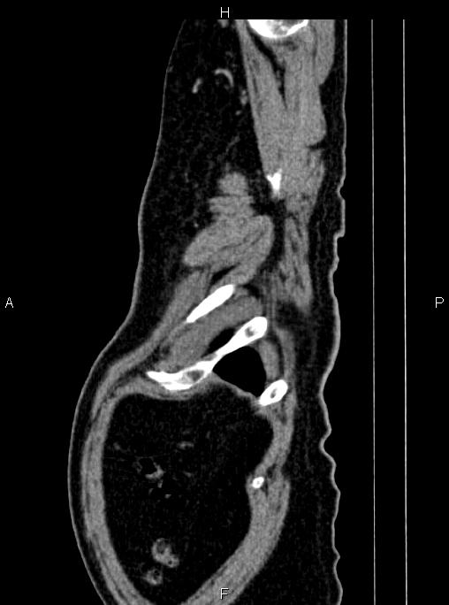 Abdominal aortic aneurysm (Radiopaedia 83094-97462 Sagittal renal cortical phase 118).jpg