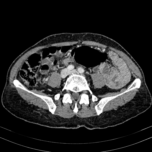 Abdominal aortic aneurysm (Radiopaedia 83581-98689 Axial C+ portal venous phase 73).jpg