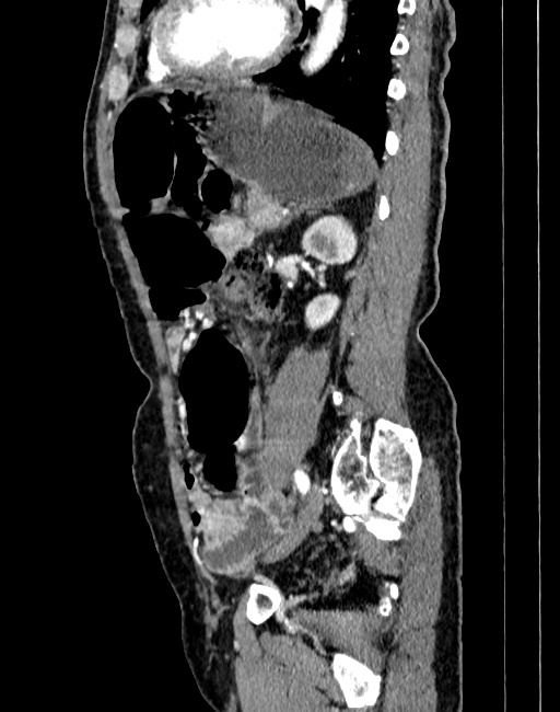Abdominal aortic aneurysm (Radiopaedia 83581-98689 Sagittal C+ arterial phase 77).jpg