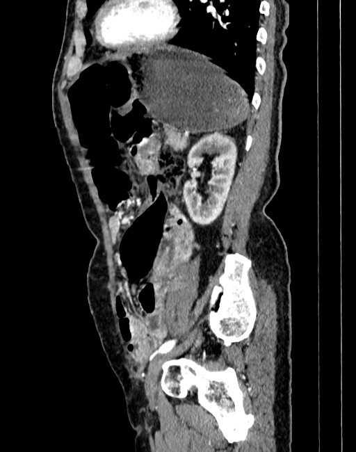 Abdominal aortic aneurysm (Radiopaedia 83581-98689 Sagittal C+ arterial phase 86).jpg