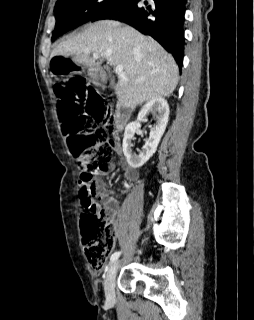 Abdominal aortic aneurysm (Radiopaedia 83581-98689 Sagittal C+ portal venous phase 5).jpg