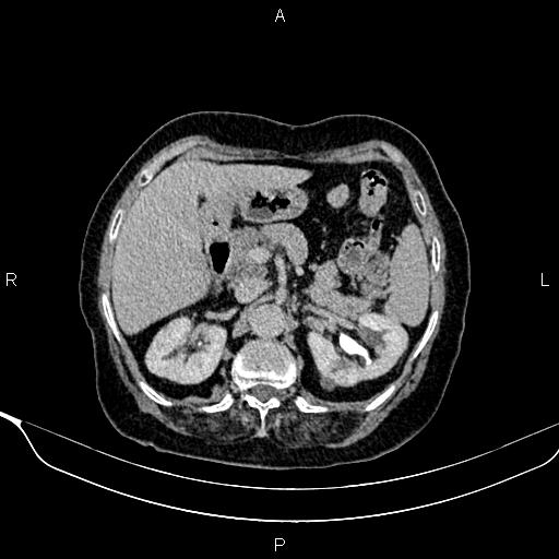 File:Abdominal aortic aneurysm (Radiopaedia 85063-100606 Axial C+ delayed 27).jpg