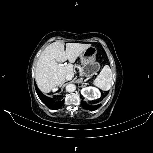File:Abdominal aortic aneurysm (Radiopaedia 85063-100606 Axial C+ portal venous phase 31).jpg