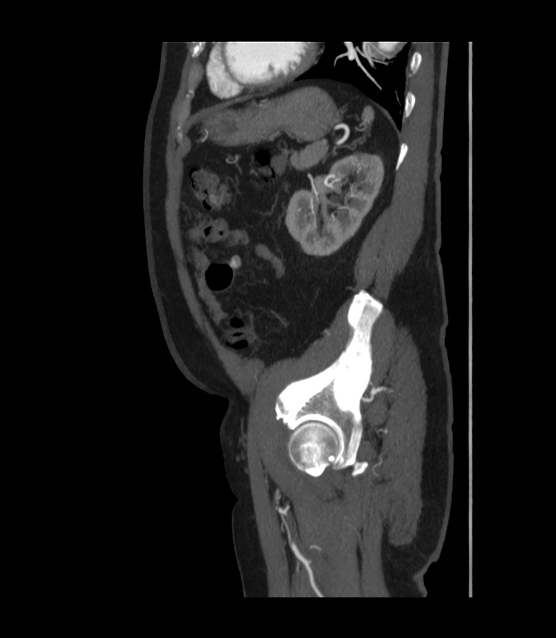Abdominal aortic aneurysm with thrombus fissuration (Radiopaedia 46218-50618 Sagittal C+ arterial phase 45).jpg