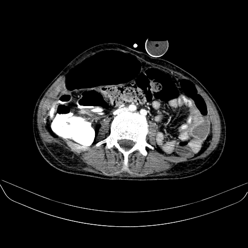 File:Abdominal collection due to previous cecal perforation (Radiopaedia 80831-94320 Axial C+ portal venous phase 116).jpg