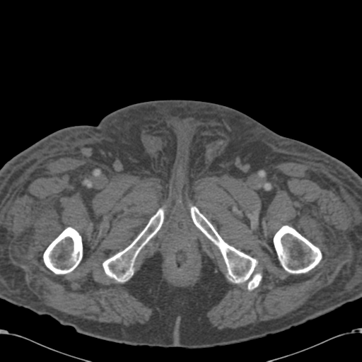 Abdominal hematoma (Radiopaedia 33614-34715 Axial C+ portal venous phase 143).png