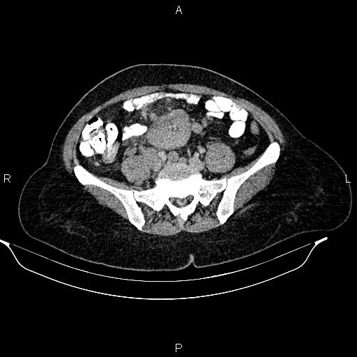 Abdominal lymphoma with sandwich sign (Radiopaedia 84378-99704 Axial C+ portal venous phase 41).jpg