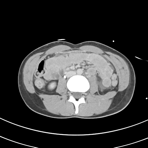 File:Abdominal multi-trauma - devascularised kidney and liver, spleen and pancreatic lacerations (Radiopaedia 34984-36486 Axial C+ delayed 41).png