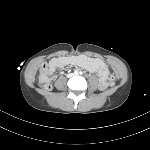 Abdominal multi-trauma - devascularised kidney and liver, spleen and pancreatic lacerations (Radiopaedia 34984-36486 Axial C+ portal venous phase 49).png