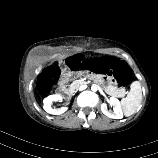 Abdominal wall hematoma with active bleeding (Radiopaedia 83915-99117 Axial renal cortical phase 20).jpg
