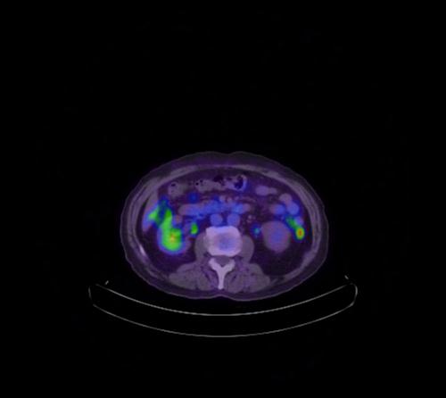 Abdominal wall metastasis from colorectal carcinoma (Radiopaedia 31016-31719 Axial 66).jpg