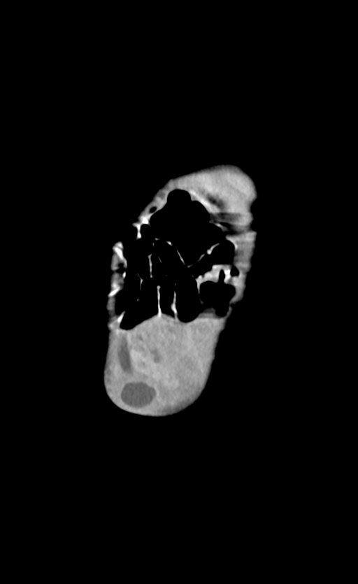 Abdominopelvic rhabdomyosarcoma (Radiopaedia 78356-90984 Coronal C+ portal venous phase 6).jpg