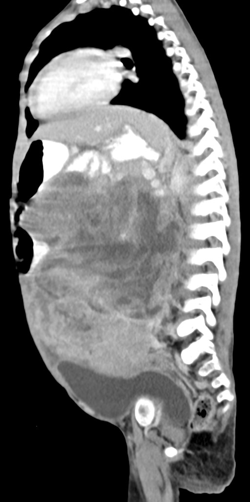 Abdominopelvic rhabdomyosarcoma (Radiopaedia 78356-90984 Sagittal C+ portal venous phase 38).jpg