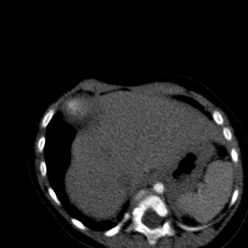 File:Aberrant left pulmonary artery (pulmonary sling) (Radiopaedia 42323-45435 Axial C+ CTPA 41).jpg