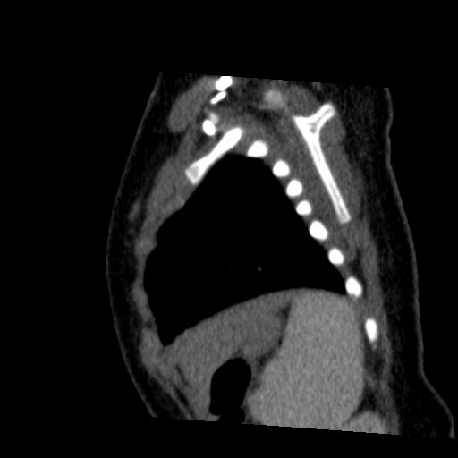 File:Aberrant left pulmonary artery (pulmonary sling) (Radiopaedia 42323-45435 Sagittal C+ arterial phase 48).jpg
