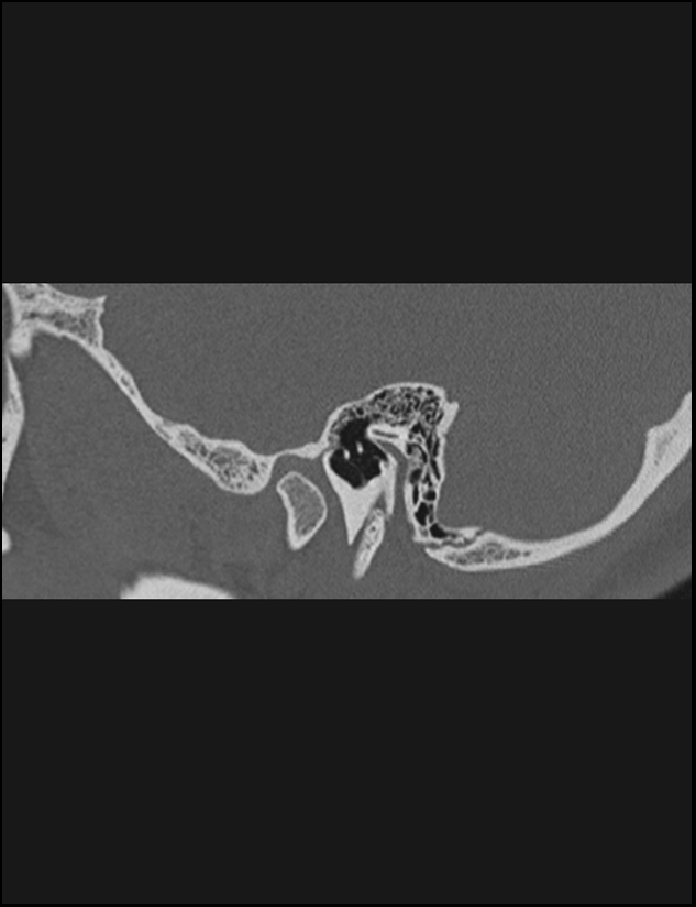 Aberrant right internal carotid artery (Radiopaedia 65191-74198 Sagittal non-contrast 43).jpg