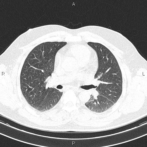 File:Aberrant right subclavian artery (Radiopaedia 87093-103354 Axial lung window 51).jpg