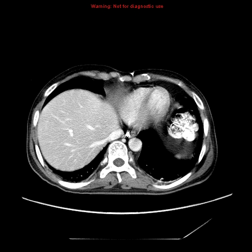 Aberrant right subclavian artery (Radiopaedia 9379-10071 Axial C+ arterial phase 53).jpg