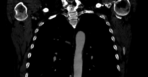 Accesory rib joint (Radiopaedia 71987-82452 Coronal bone window 9).jpg