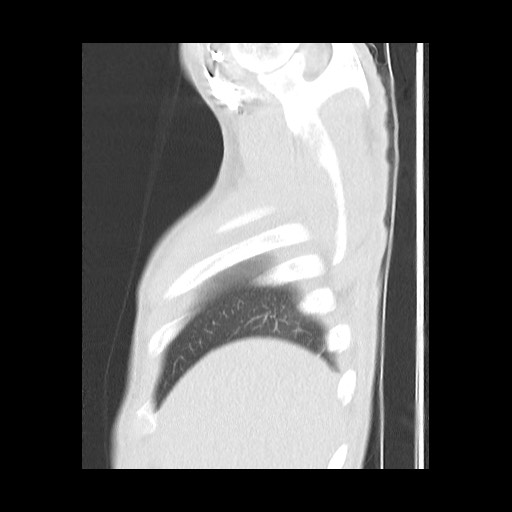 Accessory left horizontal fissure with lingular pneumonia (Radiopaedia 53763-59843 Sagittal lung window 10).jpg