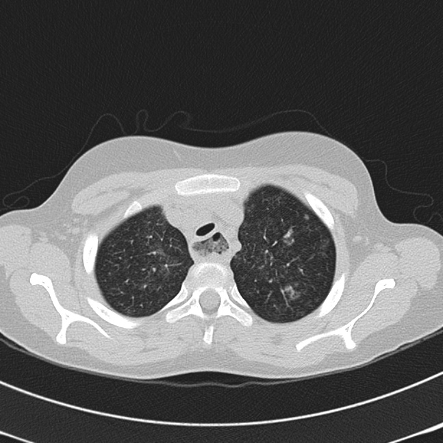 Achalasia (Radiopaedia 14946-14878 Axial lung window 11).jpg
