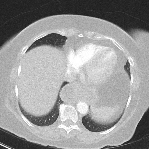 File:Achalasia (Radiopaedia 47147-51685 Axial lung window 37).png