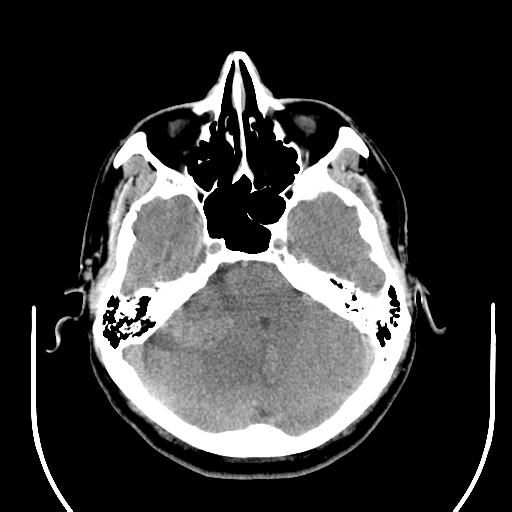 File:Acoustic schwannoma (Radiopaedia 29488-29982 AXIAL THICK non-contrast 14).jpg