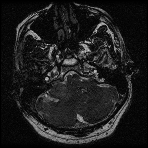 File:Acoustic schwannoma (Radiopaedia 39170-41387 Axial FIESTA 47).png