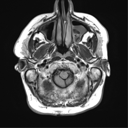File:Acoustic schwannoma (Radiopaedia 50846-56358 Axial FLAIR 3).png