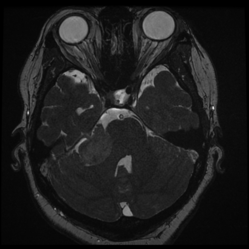 Acoustic schwannoma (Radiopaedia 57574-64536 Axial T2 53).png